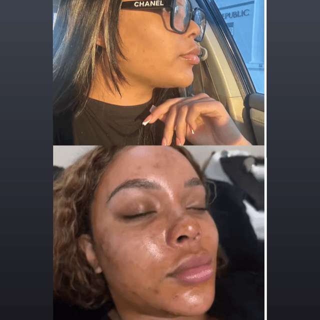 Hyperpigmentation Reset at The Vanity Club in Atlanta, GA